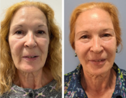 20245 04 14 Qué es una armonización facial (5)